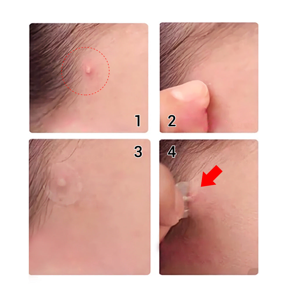 LANBNEA tea tree acne patch daily/night acne patch to fade acne marks Ultra-thin 0.1mm acne patch OEM